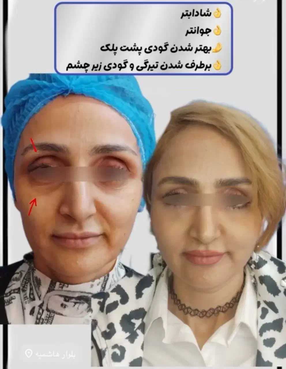 طرح اقساطی ویژه تزریق فول فیس فیلر/بایوفت و نانوفت|خدمات آرایشگری و زیبایی|مشهد, هنرستان|دیوار