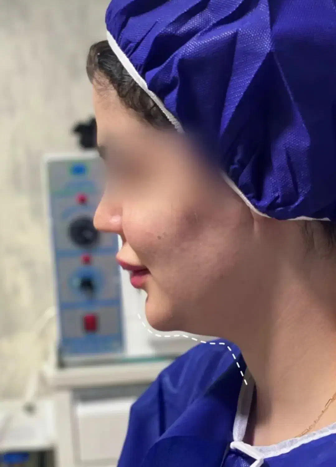 ساکشن غبغب|خدمات آرایشگری و زیبایی|یاسوج, |دیوار