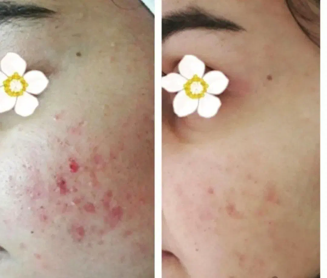 آموزش فیشیال تخصصی. مزو جوانساز صورت|خدمات آموزشی|کوهدشت, |دیوار