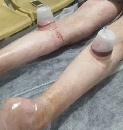 حجامت زالو فصد بادکش دیسک سیاتیک دررفتگی زردی ناف|خدمات آرایشگری و زیبایی|گنبد کاووس, |دیوار