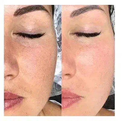 فیشیال.پاکسازی.مزو|خدمات آرایشگری و زیبایی|اهواز, کوی راه کربلا|دیوار