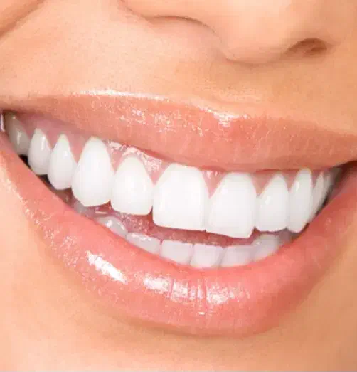 کامپوزیت بدون تراش دندان فکی ۶میلیون|خدمات آرایشگری و زیبایی|قم, شهرک مهدیه|دیوار