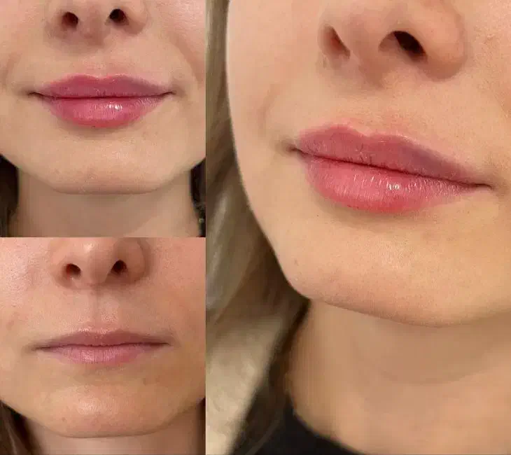 تزریق ژل وبوتاکس|خدمات آرایشگری و زیبایی|پردیس, فاز ۴|دیوار