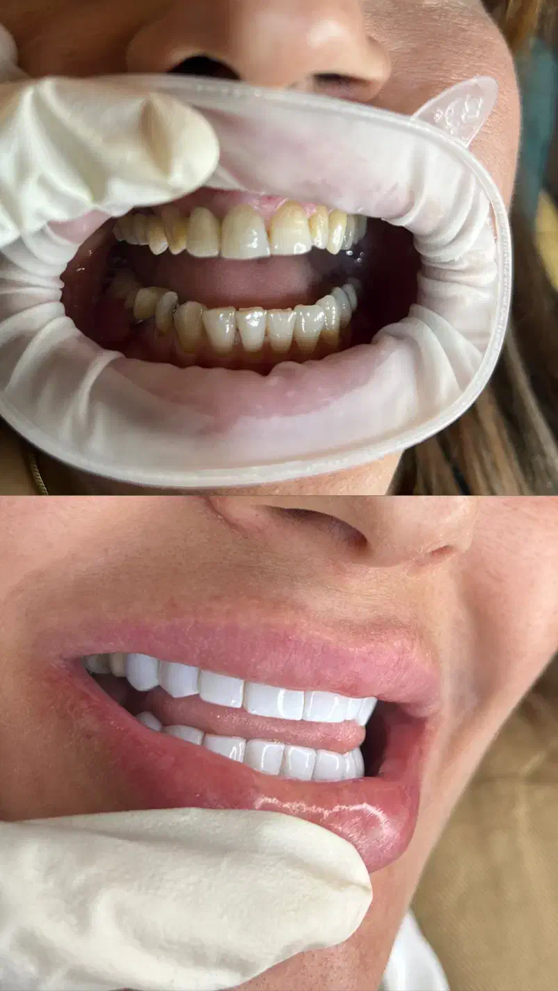 آف ویژه خدمات تخصصی کامپوزیت دندان|خدمات آرایشگری و زیبایی|شاهین‌شهر, فردوسی|دیوار