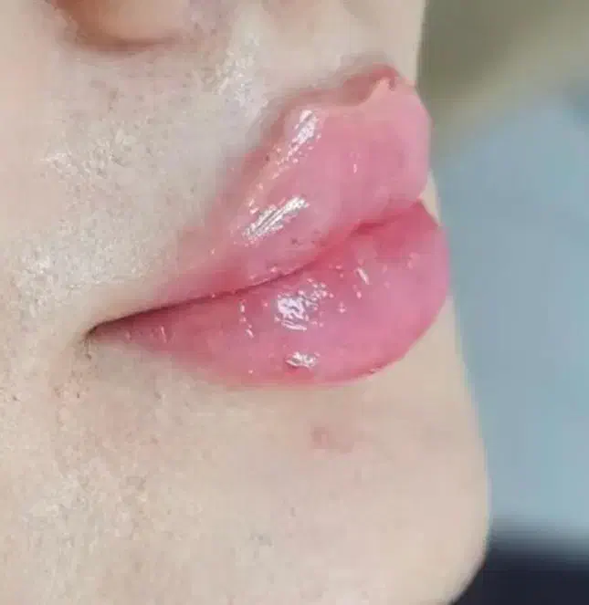 جشنواره فیلرو بوتاکس با قیمت باور نکردنی در مطب|خدمات آرایشگری و زیبایی|کرج, گوهردشت|دیوار