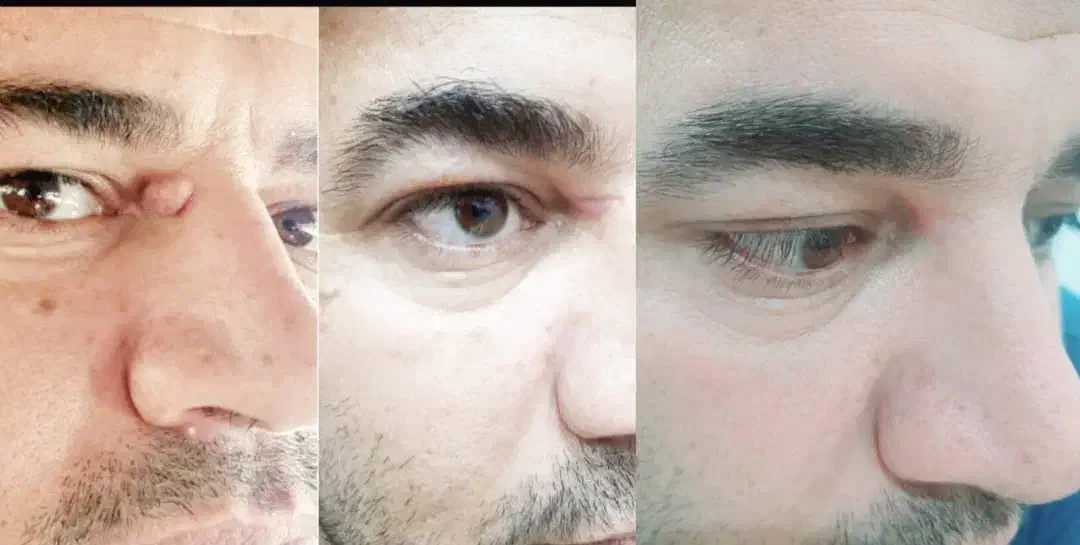 حذف وریشه کن شدن زگیل تناسلی بامحلول گیاهی|خدمات آرایشگری و زیبایی|اصفهان, بوستان ناژوان|دیوار