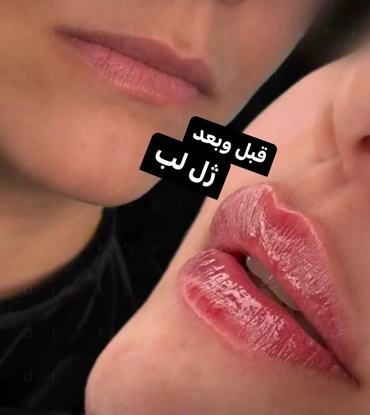 آف تزریق ژل وبوتاکس ومزوژل جوانساز|خدمات آرایشگری و زیبایی|آمل, |دیوار