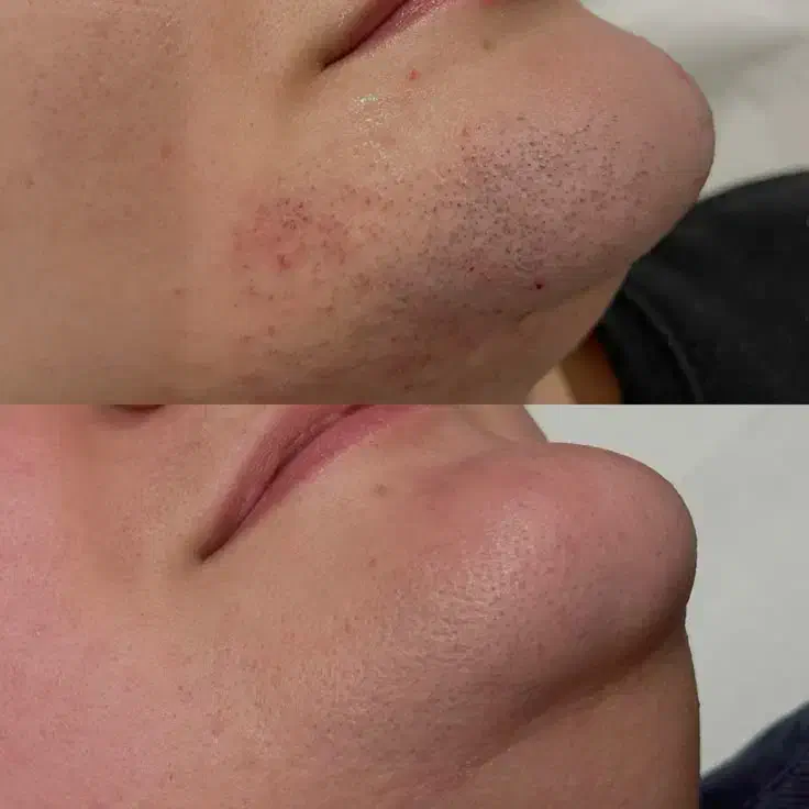 لیزر موهای زائد در مطب پزشک|خدمات آرایشگری و زیبایی|زنجان, |دیوار