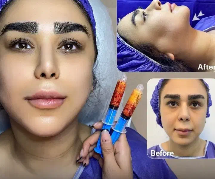 تزریق چربی به صورت وساکشن شکم وپهلو|خدمات آرایشگری و زیبایی|نهاوند, |دیوار