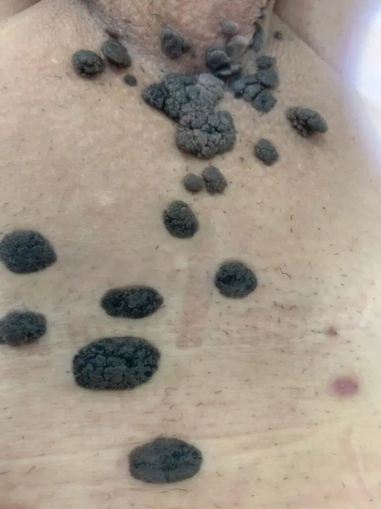 زگیل/hpv|آرایشی، بهداشتی، درمانی|بندر ماهشهر, |دیوار