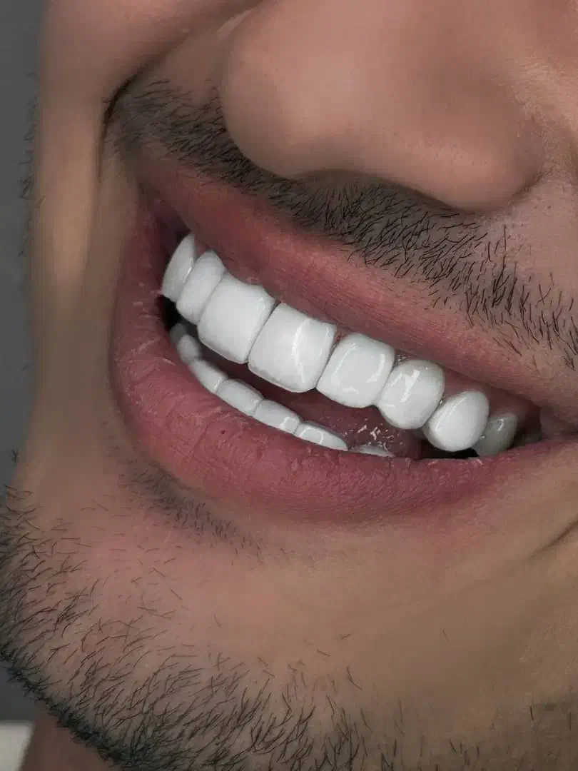 جشنواره کامپوزیت لمینیت روکش عصب ترمیم IMAX IPS|خدمات آرایشگری و زیبایی|تهران, هفت حوض|دیوار