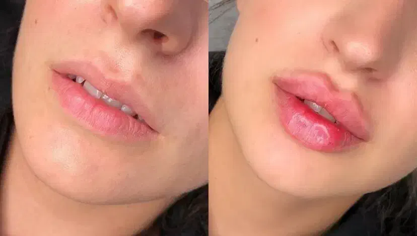 ژل لب روسی مادلینگ عربی زاویه سازی بوتاکس بادی|خدمات آرایشگری و زیبایی|تهران, سعادت‌آباد|دیوار