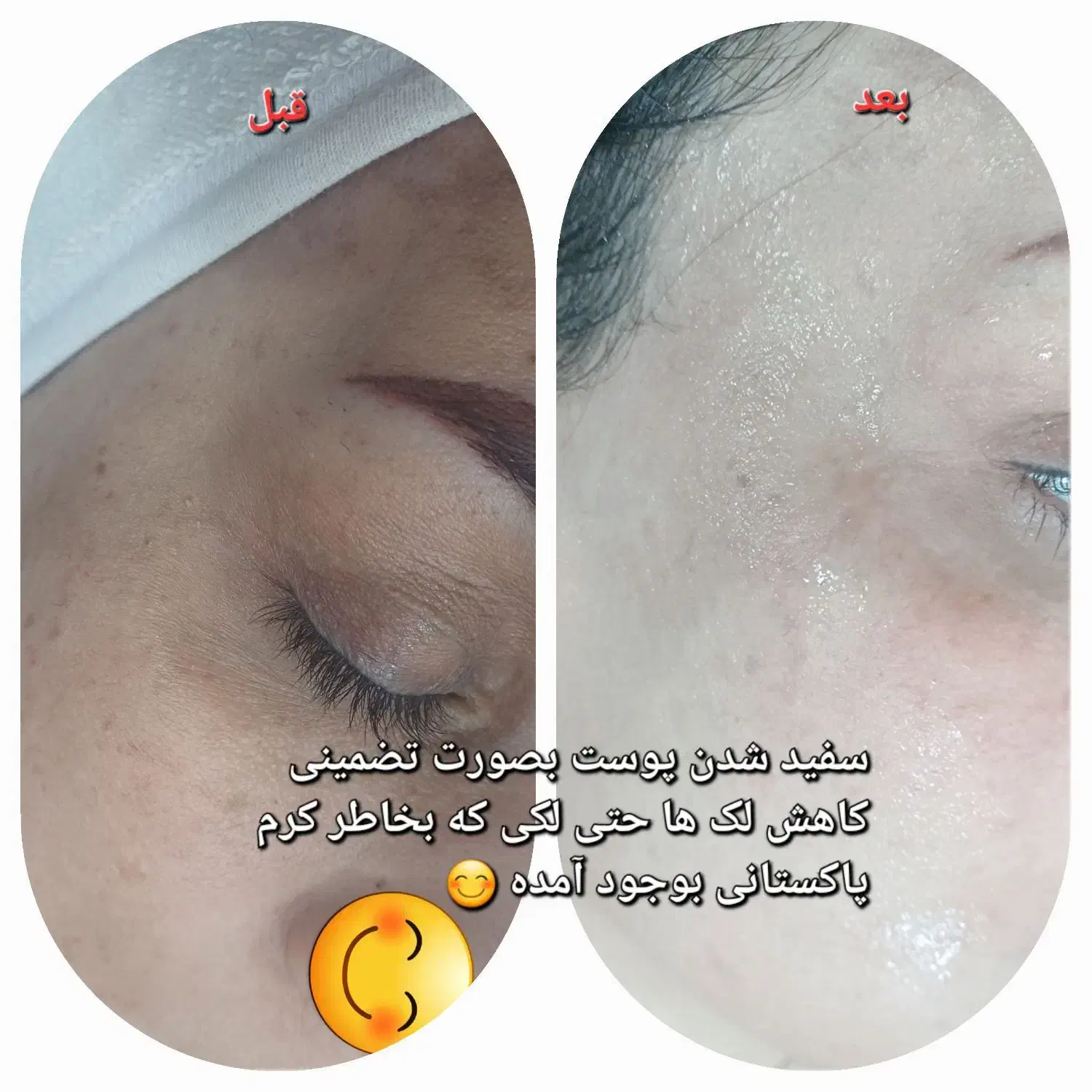 لک جوش و منافذ و جای جوش و لیفت و جوانسازی صورت|خدمات آرایشگری و زیبایی|زاهدان, |دیوار