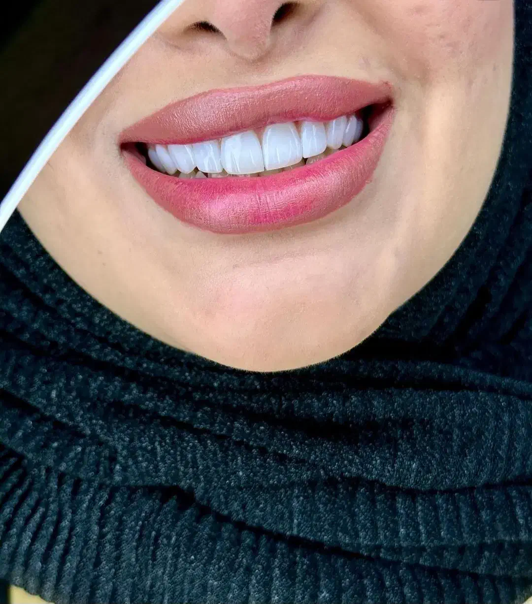 جشنواره کامپوزیت لمینیت عصب IPS IMAX روکش N2 ونیر|خدمات آرایشگری و زیبایی|تهران, هفت حوض|دیوار