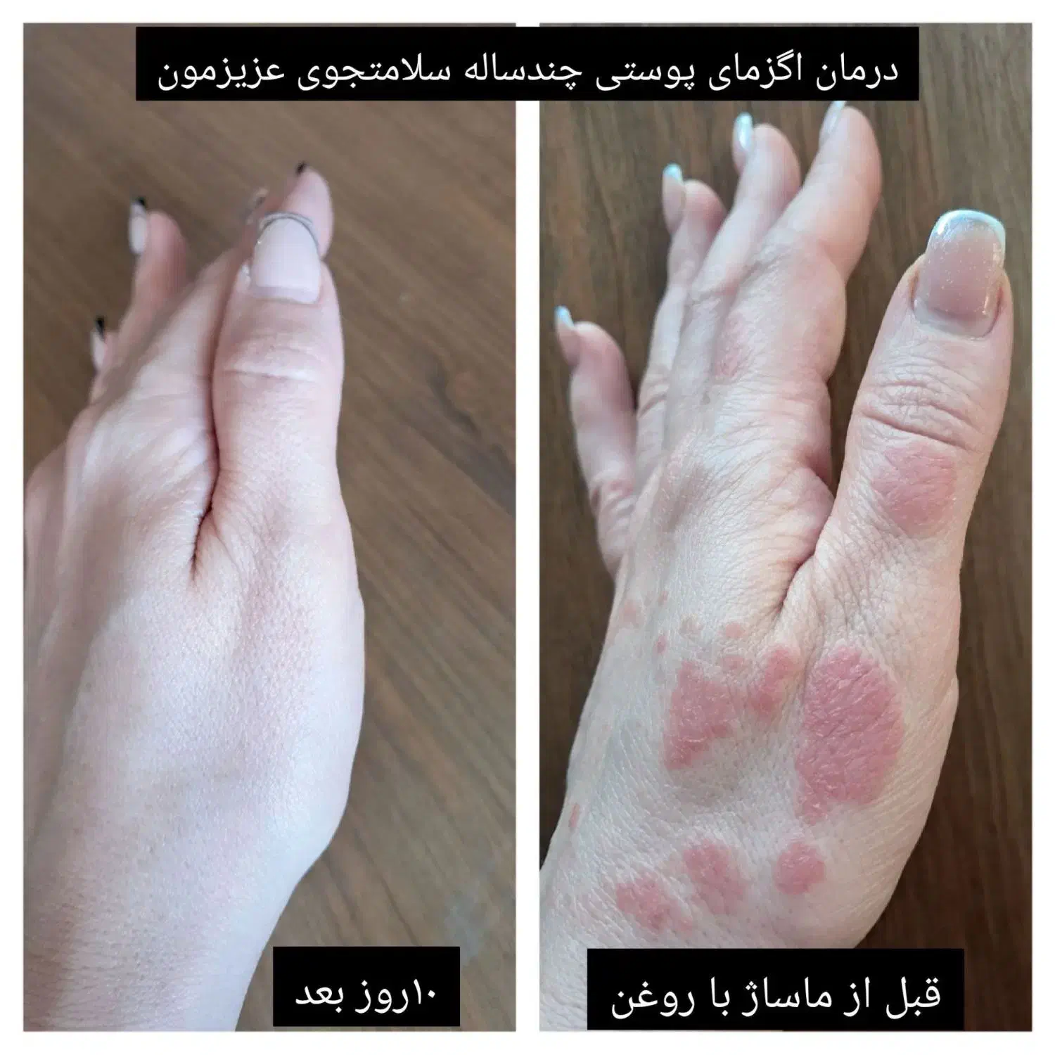 درمان مشکلات پوستی اگزما لک|آرایشی، بهداشتی، درمانی|سرخنکلاته, |دیوار