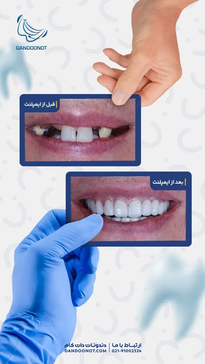 ایمپلنت کره ای و سوئیسی یک روزه|پزشکی|قزوین, |دیوار