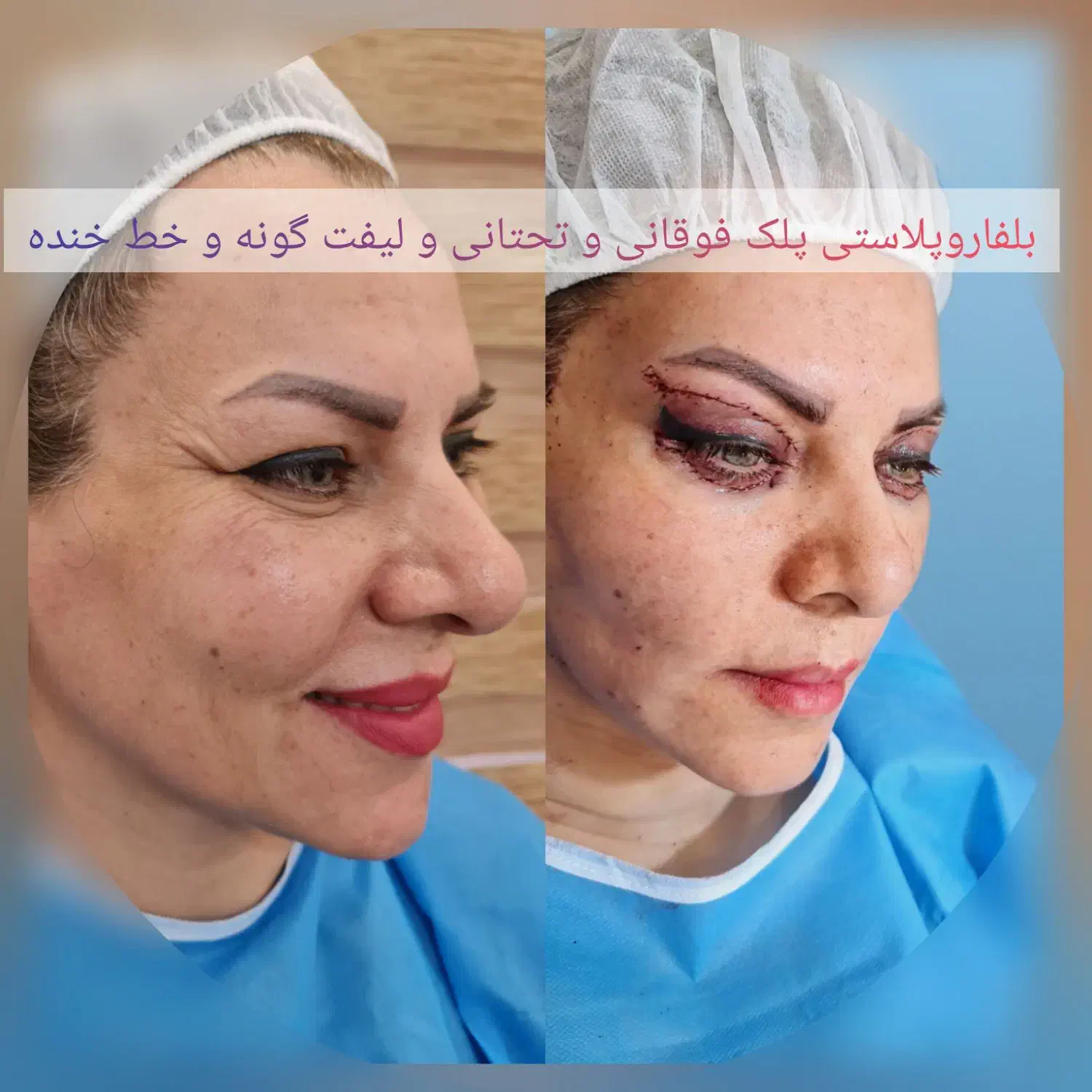 جشنواره پائیزی جراحی پلک.شقیقه.ابرو.سانترال لب.|خدمات آرایشگری و زیبایی|زاهدان, |دیوار