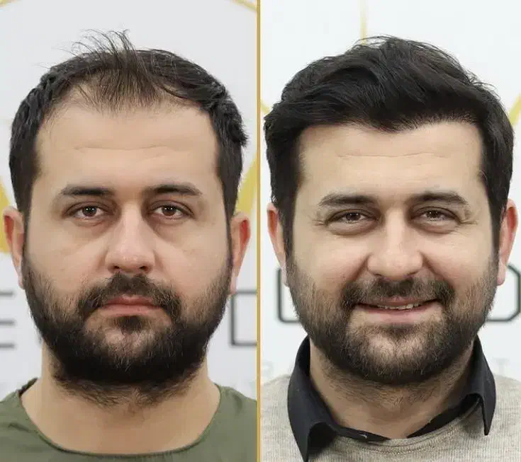 کاشت موی تضمینی با خط رویش 100٪ طبیعی|خدمات آرایشگری و زیبایی|شهرکرد, |دیوار