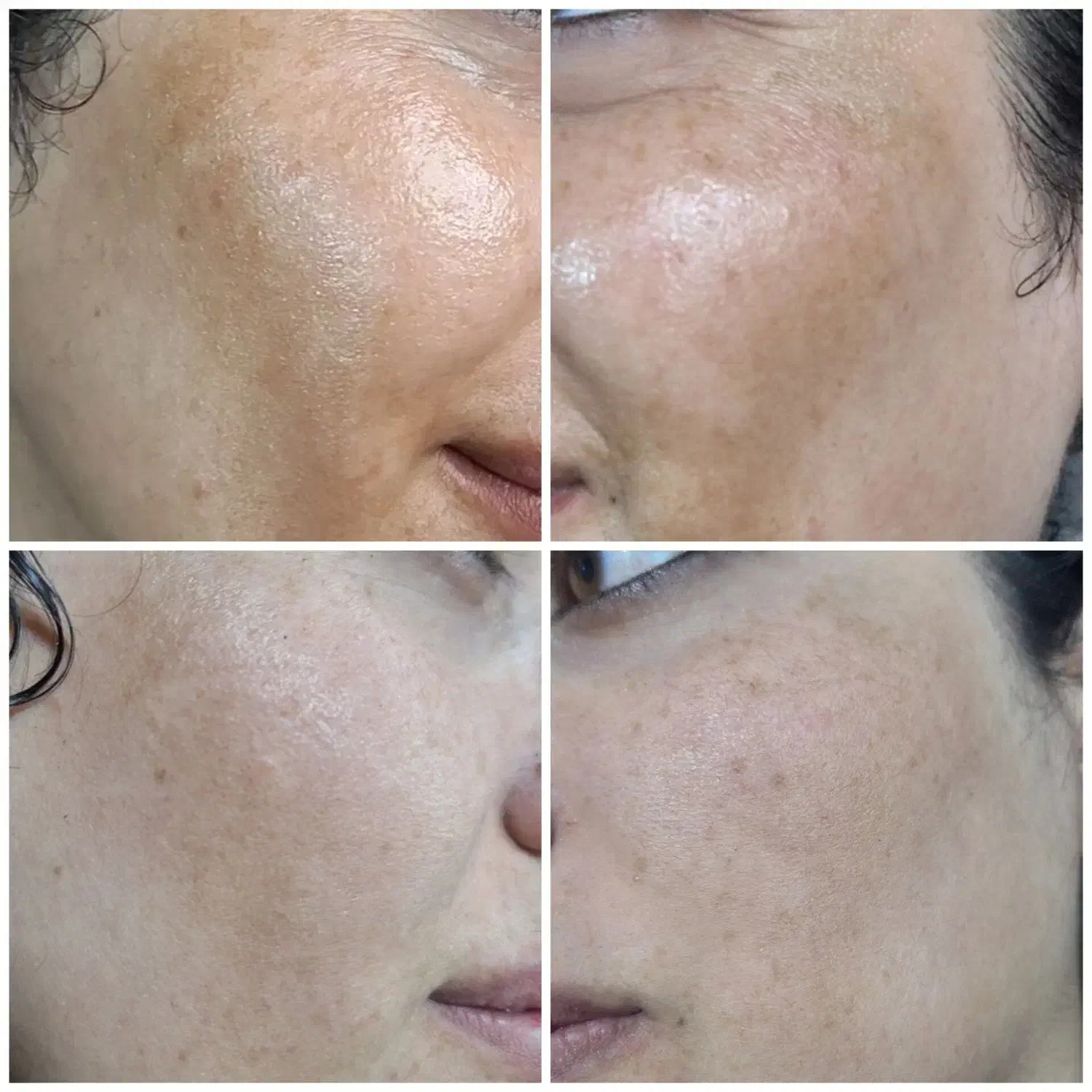 مزوتراپی ، PRP و مزونیدلینگ|خدمات آرایشگری و زیبایی|دوگنبدان, |دیوار