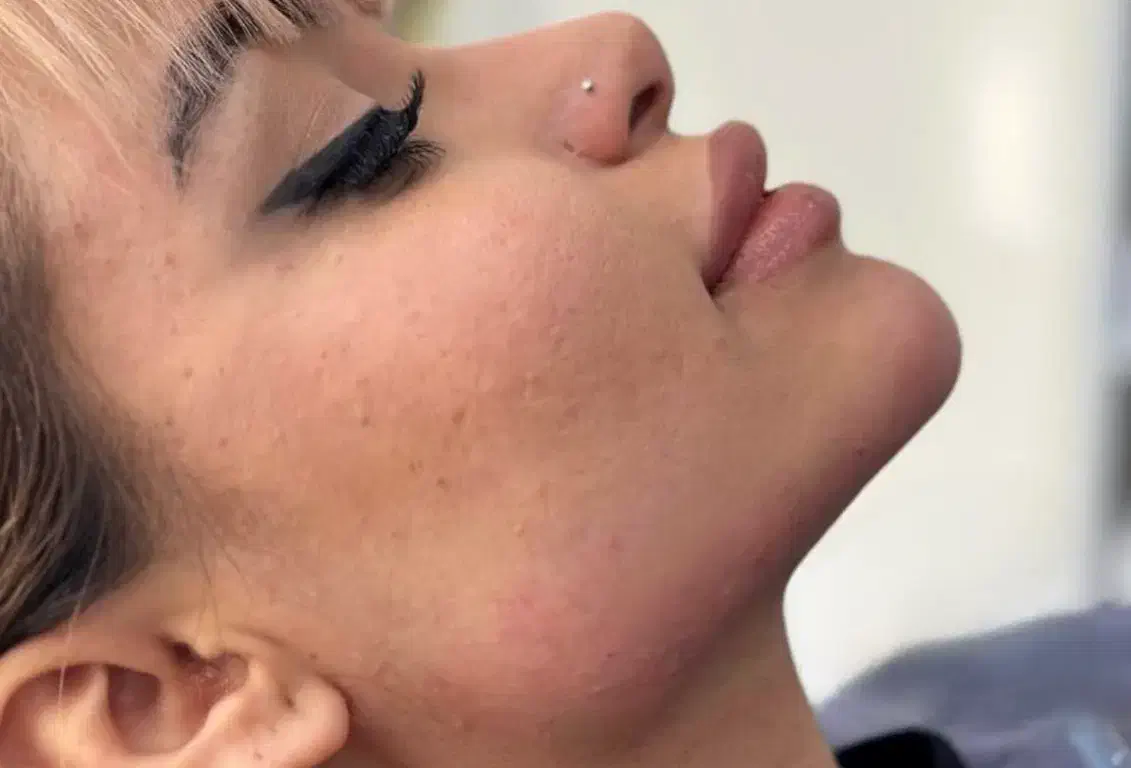 تزریق ژل لب بوتاکس مزو انزیم کانتورینگ لیفت صورت|خدمات آرایشگری و زیبایی|تهران, سعادت‌آباد|دیوار