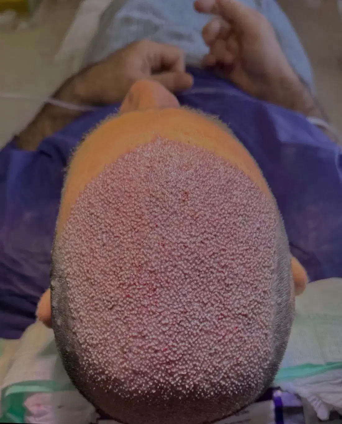 کاشت مو ی پر تراکم|خدمات آرایشگری و زیبایی|ساری, |دیوار