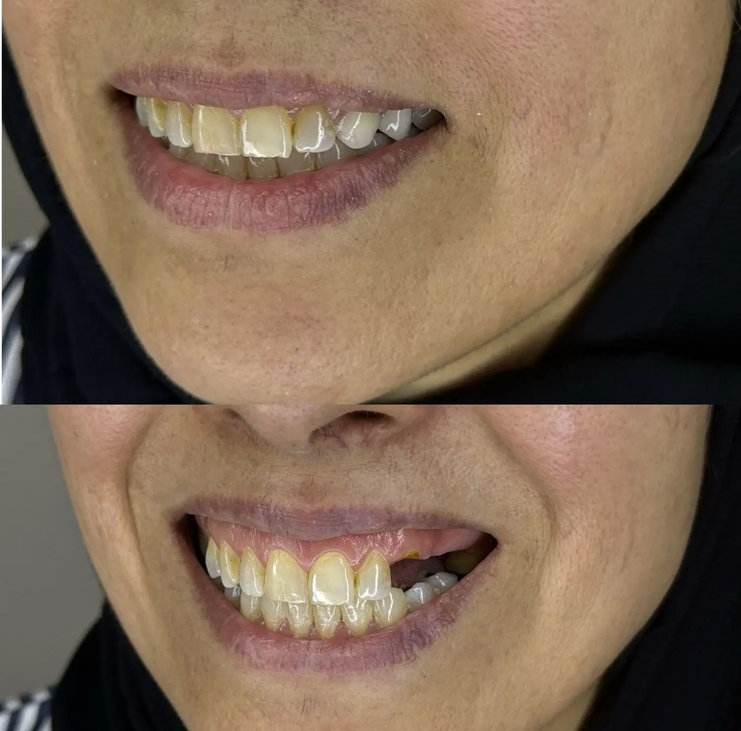 دندان مصنوعی + اقساط با چک + با گارانتی|خدمات زیبایی و سلامت|تهران, مهرآباد|دیوار