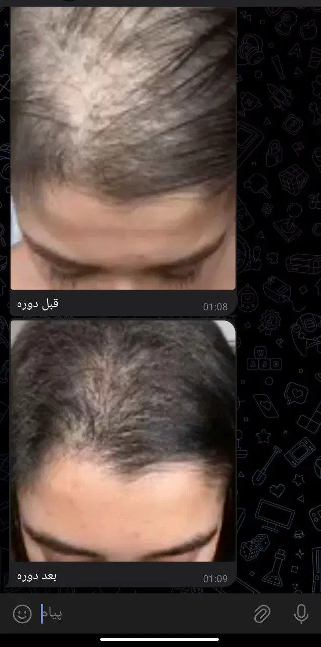 قطع ریزش در دوهفته|آرایشی، بهداشتی، درمانی|خوسف, |دیوار