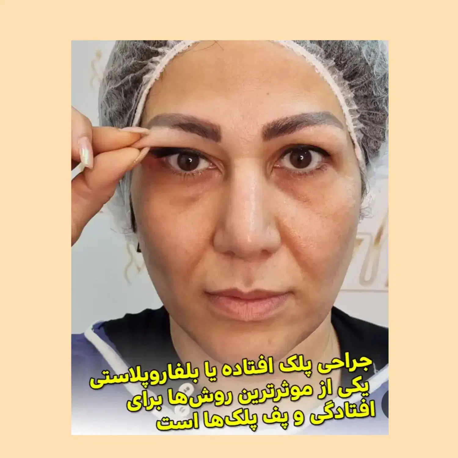 عمل بلفارو وتزریق بوتاکس فیلر وچربی وساکشن غبغب|خدمات آرایشگری و زیبایی|اصفهان, خوراسگان|دیوار