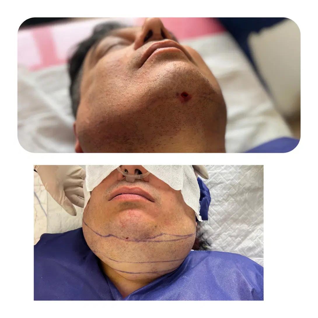 لیپو ابدو ژل بوتاکس کاشت ،غبغب، بلفارو،تزریق چربی|خدمات زیبایی و سلامت|تهران, شمسآباد|دیوار