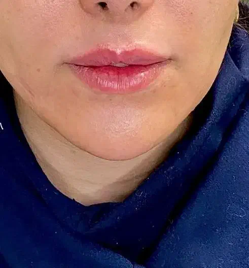 تزریق ژل وفیلر۳۹۹تومن|خدمات آرایشگری و زیبایی|رباطکریم, رباطکریم|دیوار