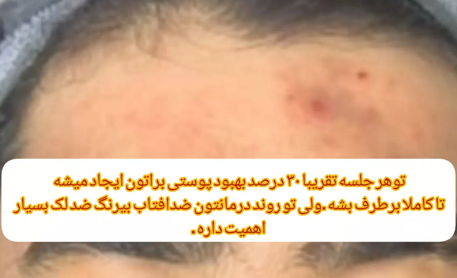 جای جوش و ابله و لک جوش|خدمات آرایشگری و زیبایی|دورود, |دیوار