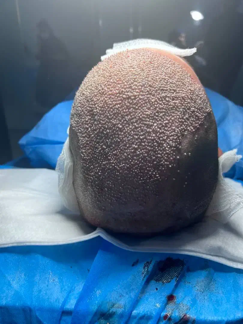 کاشت مو تخصصی|خدمات آرایشگری و زیبایی|پارس‌آباد, |دیوار