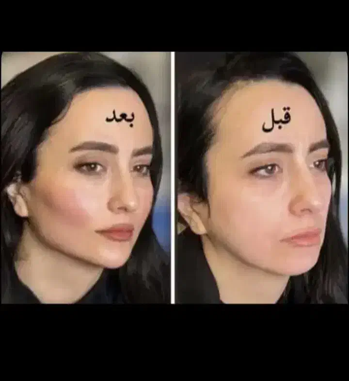 جشنواره ی پاییزه ی فیلر وبوتاکس|خدمات آرایشگری و زیبایی|ارومیه, |دیوار