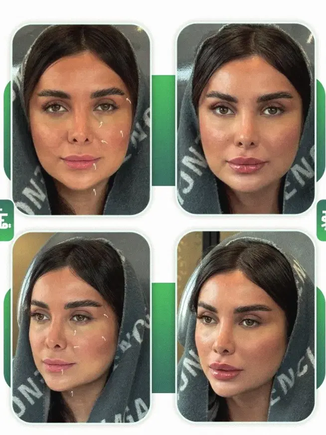 بوتاکس|خدمات آرایشگری و زیبایی|همدان, |دیوار