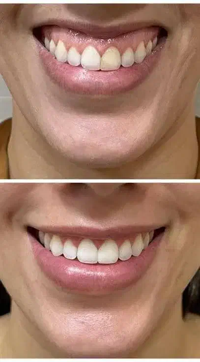 بمب تخفیف ژل و بوتاکس|خدمات آرایشگری و زیبایی|بندر امام خمینی, |دیوار