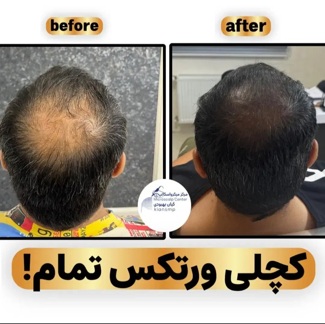 شبیه سازی فولیکول مو smp اس کالپ|خدمات آرایشگری و زیبایی|دوگنبدان, |دیوار