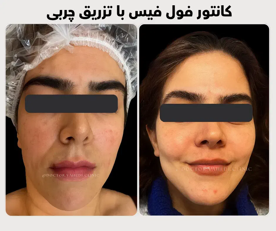 تزریق چربی صورت با ماندگاری ۱۰ ساله - دکتر واحدی|خدمات آرایشگری و زیبایی|قزوین, |دیوار