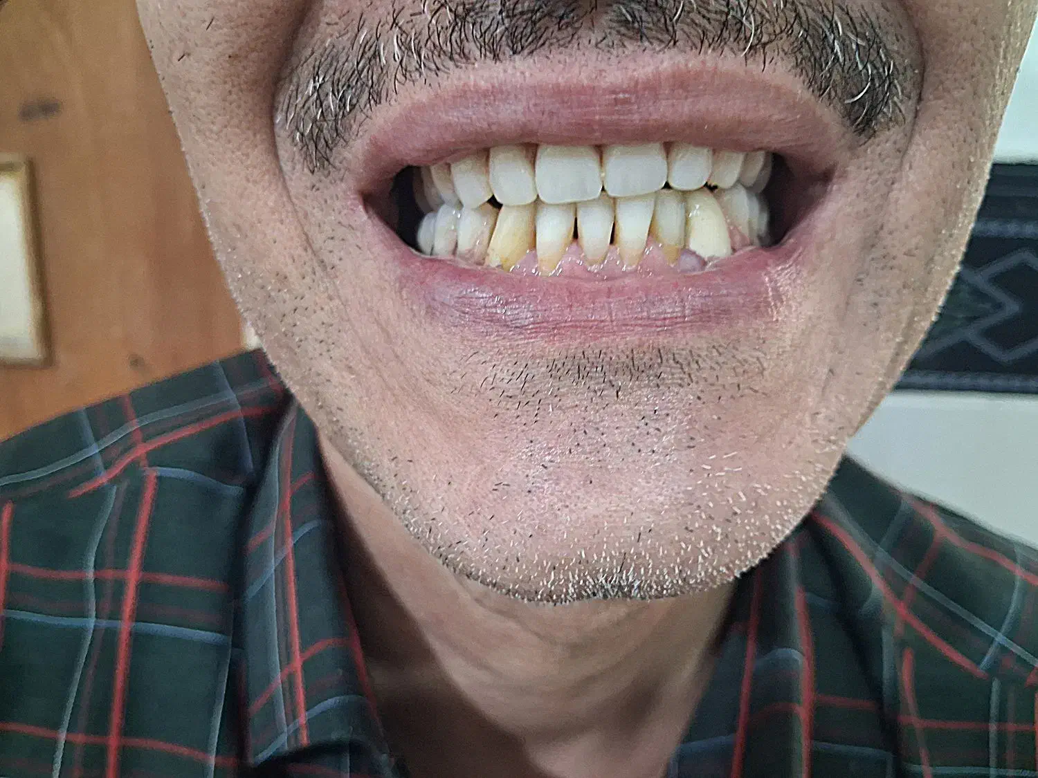 پروتز دندان|خدمات آرایشگری و زیبایی|ابهر, |دیوار