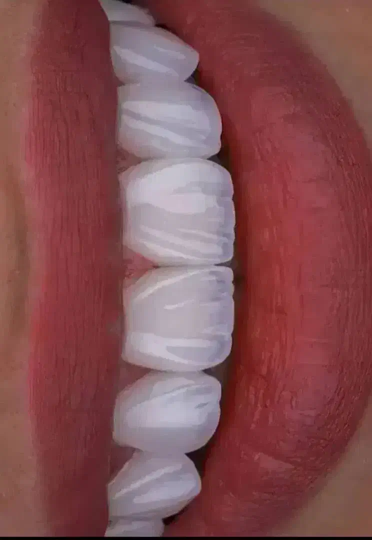 دندانپزشکی ، ایمپلنت، روکش، کامپوزیت ، عصب کشی|خدمات آرایشگری و زیبایی|کوهدشت, |دیوار