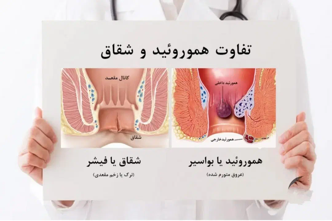 بواسیر شقاق یبوست|آرایشی، بهداشتی، درمانی|میاندوآب, |دیوار