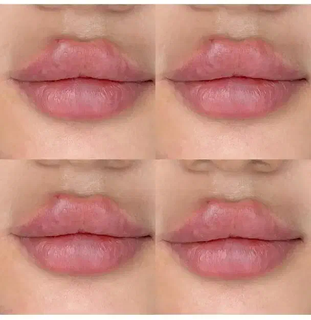 آموزش ژل ،بوتاکس، پی آر پی|خدمات آموزشی|شوشتر, |دیوار