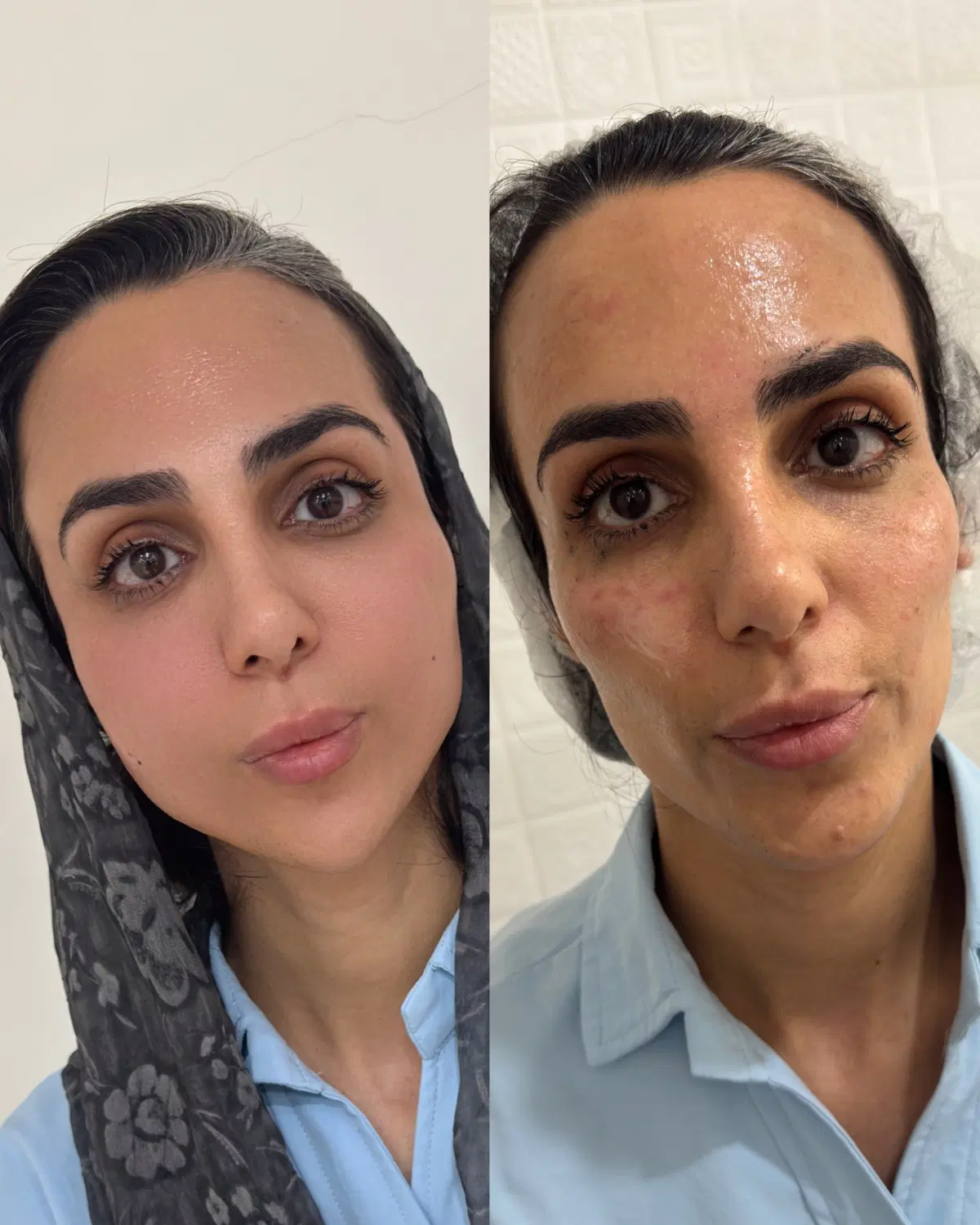 مدل جهت تزریق چربی/انجام بلفاروپلاستی|خدمات زیبایی و سلامت|تهران, شکوفه (عبدل آباد)|دیوار