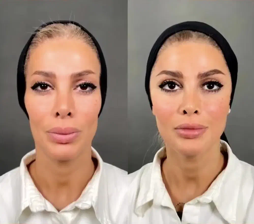 تخفیف خدمات مدلینگ فیلر بوتاکس مزوژل خانم و آقا|خدمات آرایشگری و زیبایی|تهران, پاسداران|دیوار