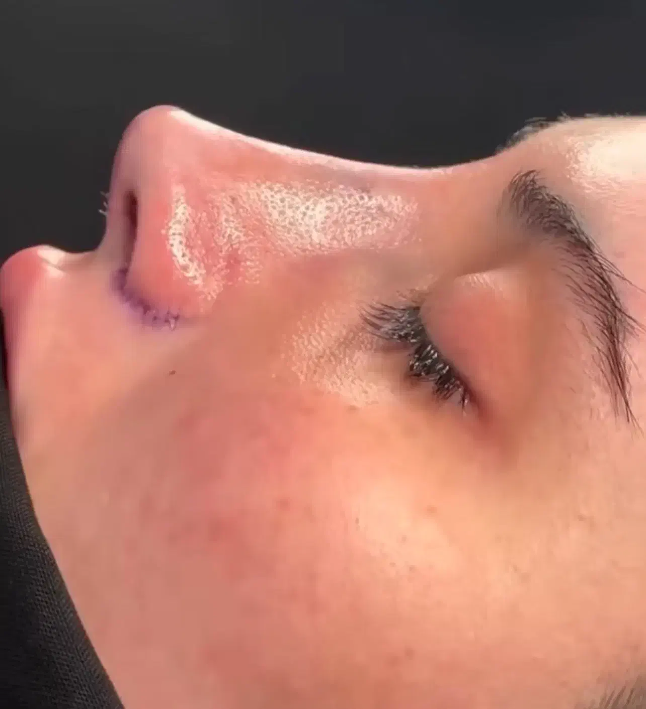 جراحی زیبایی بینی توسط جراح متخصص گوش و‌حلق و بینی|خدمات آرایشگری و زیبایی|قوچان, |دیوار