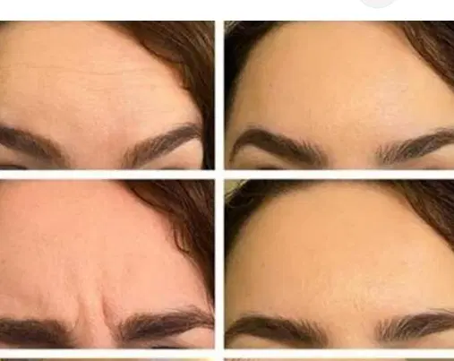 بوتاکس تخصصی در کلینیک زیبایی برنا|خدمات زیبایی و سلامت|اصفهان, وحید|دیوار