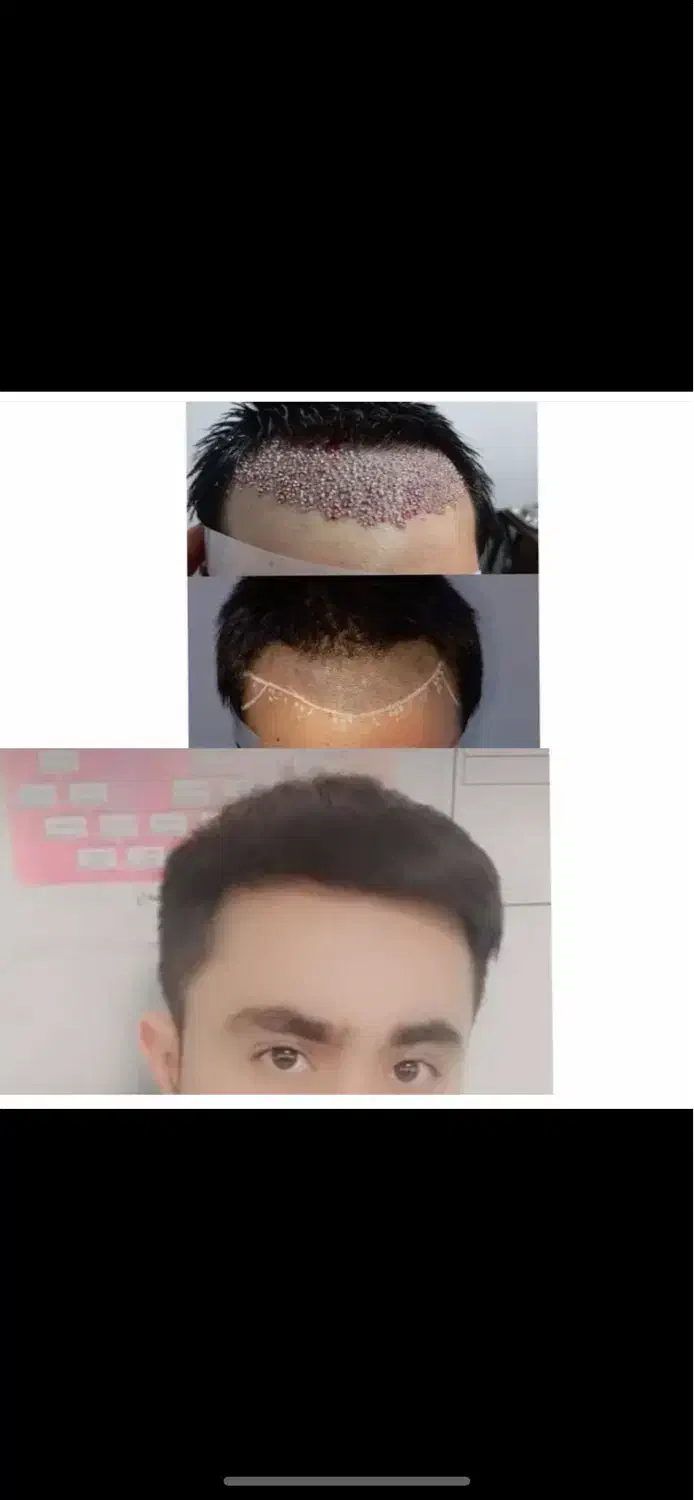 کاشت تخصصی مو وابرو|خدمات آرایشگری و زیبایی|یاسوج, |دیوار