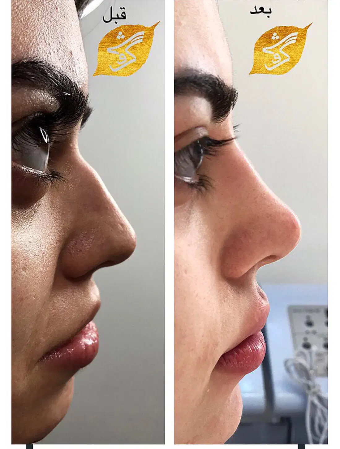 تزریق آنزیم و فیلر بینی|خدمات آرایشگری و زیبایی|تهران, پاسداران|دیوار