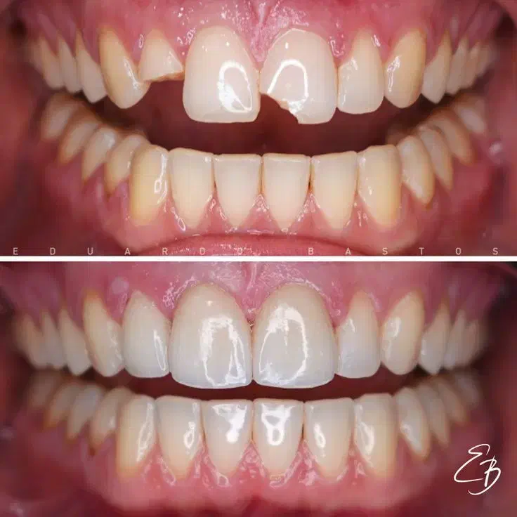 خدمات کامپوزیت دندان و زیبایی دندان|خدمات آرایشگری و زیبایی|زنجان, |دیوار