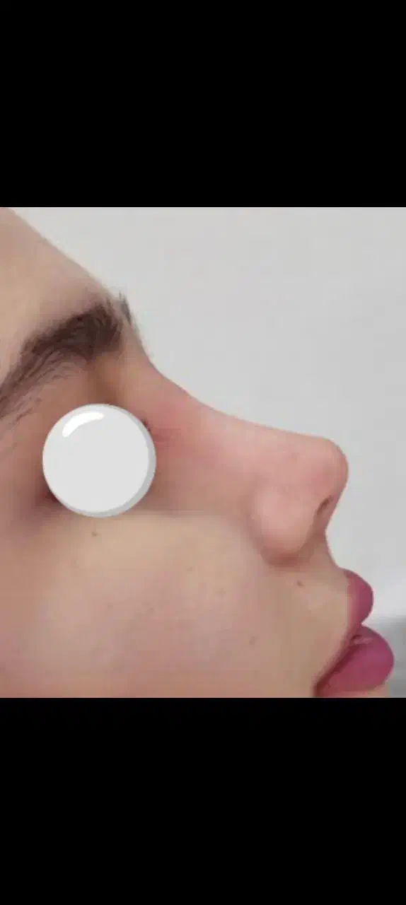 عمل زیبایی بینی|خدمات آرایشگری و زیبایی|زنجان, |دیوار