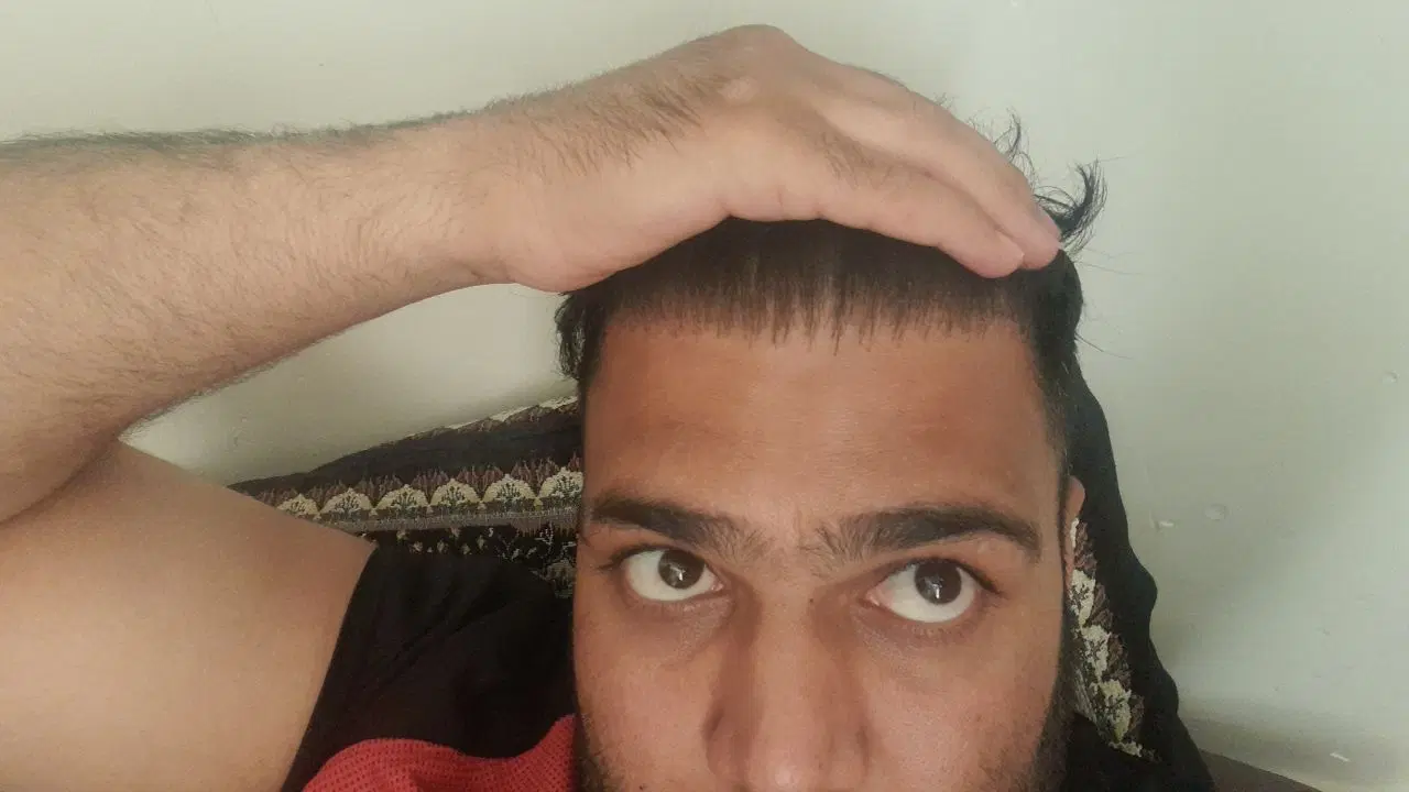 کاشت مو با 30 میلیون و شرایط اقساط|خدمات آرایشگری و زیبایی|بوکان, |دیوار